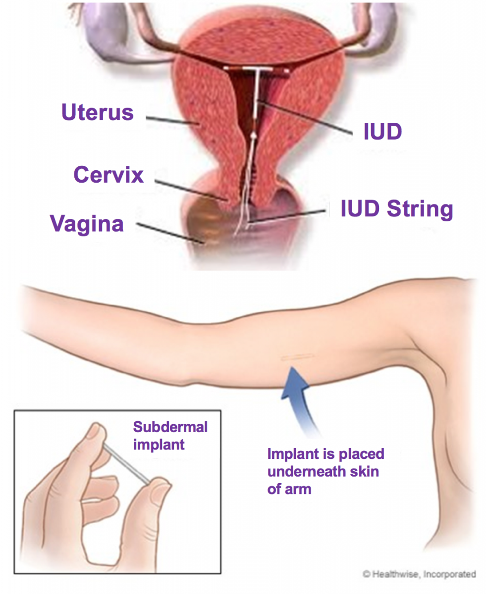 Iud In Arm How To Use Your Birth Control To Prevent Pms Women S 